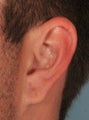 Earlobe Gauge Repair