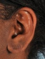 Earlobe hole Repair