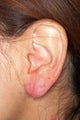 Earlobe Repair