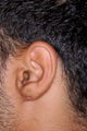 Earlobe Repair