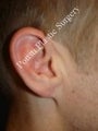 Earlobe Repair Surgery