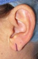 Split Ear Lobe Surgery