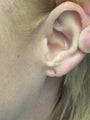 Torn Ear Lobe Repair