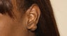 Earlobe Keloid 