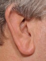 Earlobe Reduction