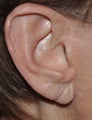 Earlobe Reduction