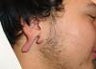 Repair of split earlobe