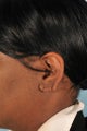 Earlobe Repair