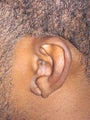 Torn Earlobe Repair
