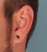 Earlobe Gauge Repair