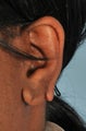 Earlobe hole Repair