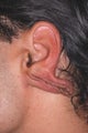 Earlobe Repair