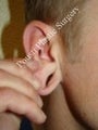 Earlobe Repair Surgery