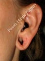Earlobe Repair Surgery