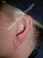Earlobe Repair Surgery