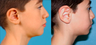 Otoplasty - Ear pinning surgery