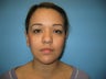 Otoplasty