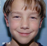 Ear Repositioning - Otoplasty