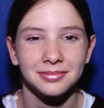 Ear Repositioning Surgery - Otoplasty