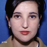 Ear Repositioning Surgery - Otoplasty