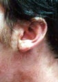Otoplasty Photo