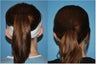 Otoplasty