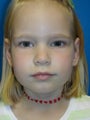 Otoplasty 