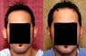 Otoplasty or ear push back surgery