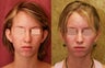 Otoplasty or ear push back surgery