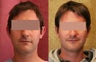 Otoplasty or ear push back surgery