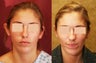 Otoplasty or ear push back surgery