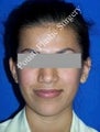 Ear Surgery (Otoplasty)