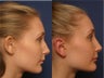 Otoplasty & Rhinoplasty