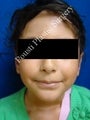 Ear Surgery (Otoplasty) 