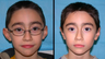 Otoplasty - Ear pinning surgery