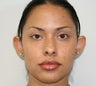 Otoplasty