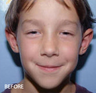 Ear Repositioning - Otoplasty