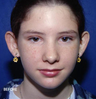 Ear Repositioning Surgery - Otoplasty