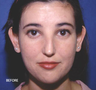 Ear Repositioning Surgery - Otoplasty
