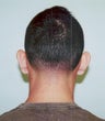 Otoplasty - Bilateral protruding ears