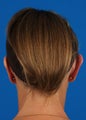 Otoplasty 
