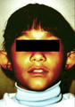 Otoplasty