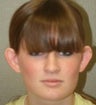Otoplasty