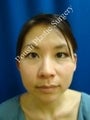 Ear Surgery (Otoplasty)