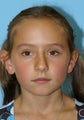 Otoplasty