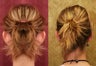 Otoplasty or ear push back surgery