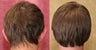 Otoplasty or ear push back surgery