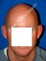 Ear Surgery (Otoplasty)