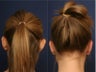 Otoplasty & Rhinoplasty