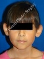 Ear Surgery (Otoplasty) 